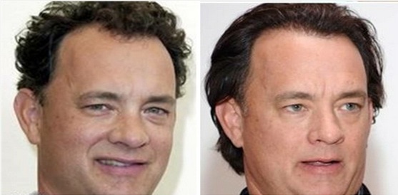 Hair Transplantation Of Tom Hanks